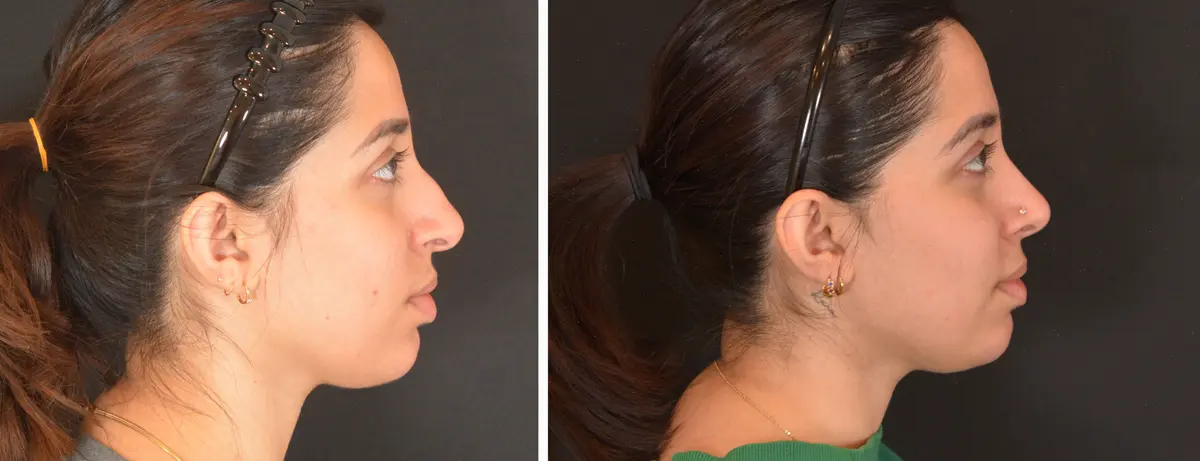 T 003 Rhinoplasty